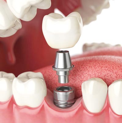 smile crafters dental implants